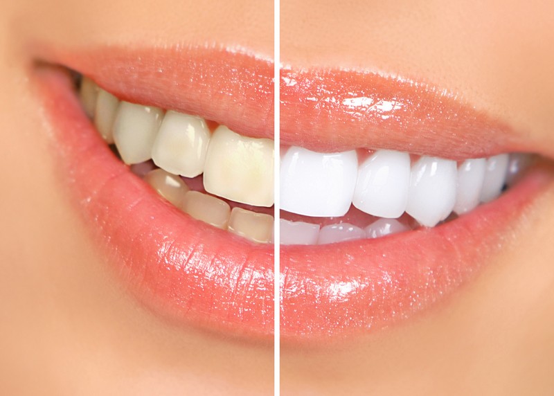 Teeth Whitening  Florence, KY 